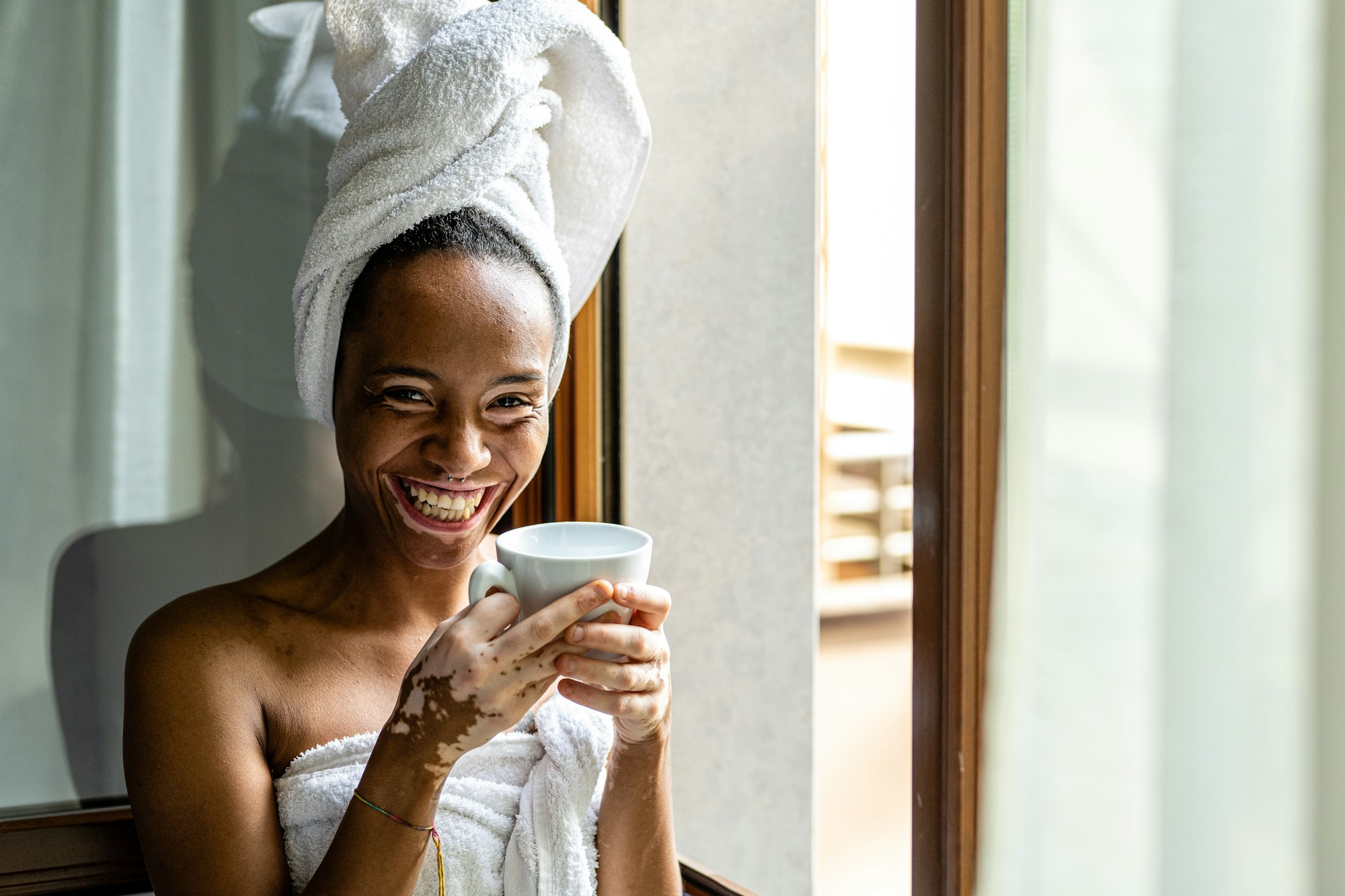 Portrait of young Brazilian woman with Vitiligo on face and hands, skin care and medical concept